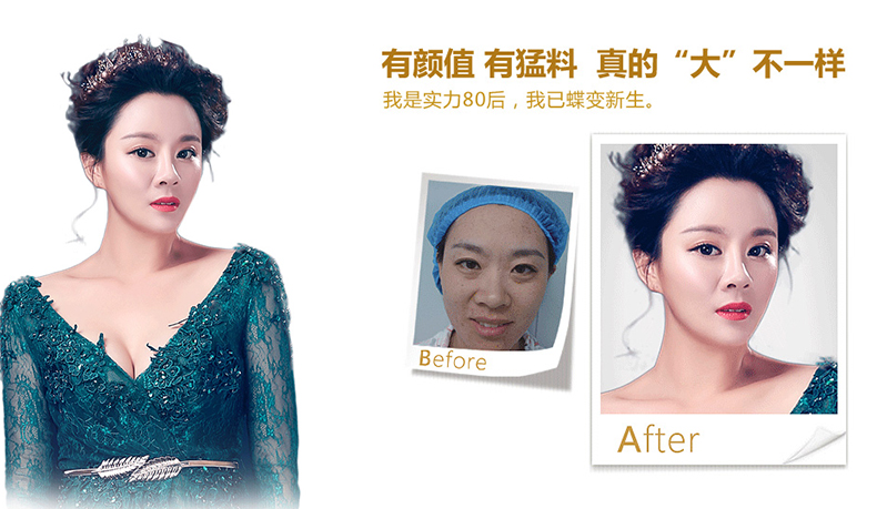 海东地区脂肪移植、隆鼻